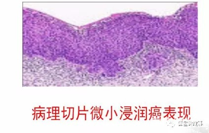 重大疾病之最低敌人-恶性肿瘤