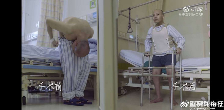 身体被敲断4次的折叠人出院，他花了20几年只为了成正常人