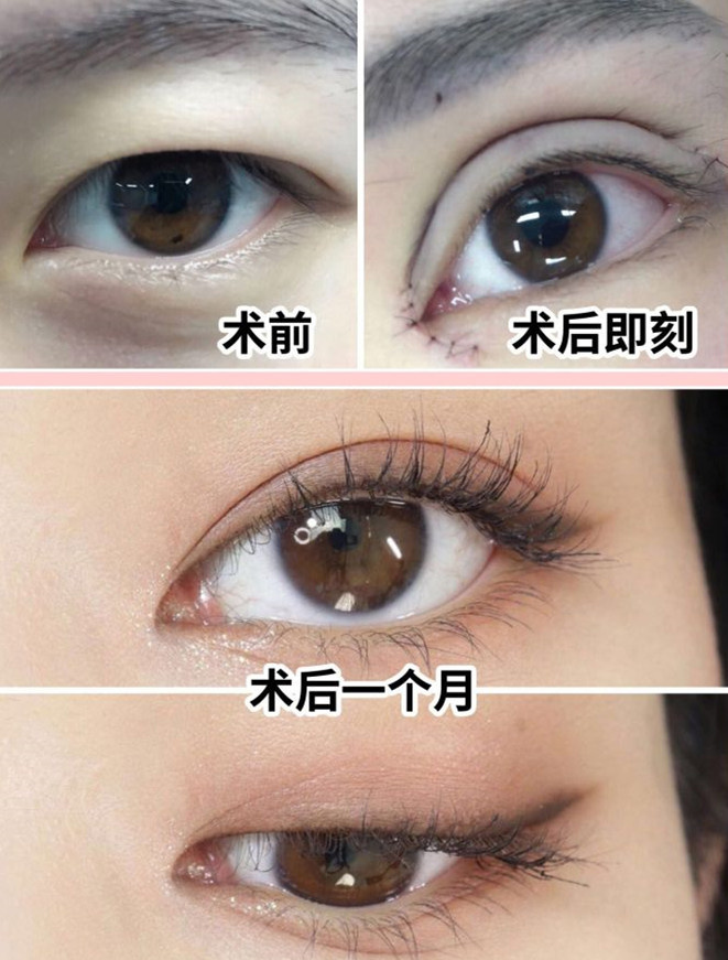 贵阳做双眼皮的医院,贵州省二医整形科双眼皮