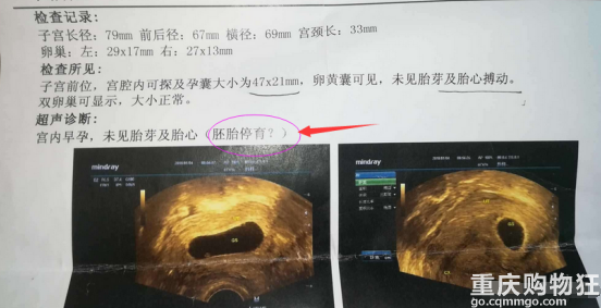 致胎停育女性：别乱保胎了！有可能适得其反