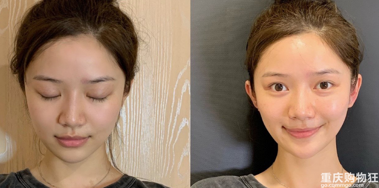 wanghong整容做成精灵耳，有人说是一种病态审美，正常耳朵整成精灵耳