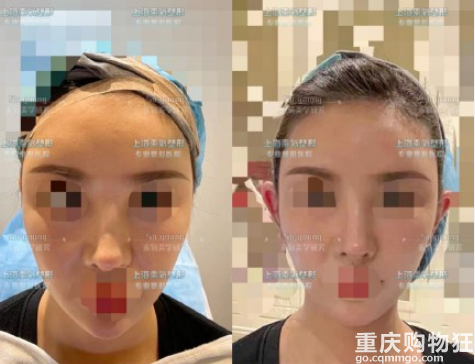 wanghong整容做成精灵耳，有人说是一种病态审美，正常耳朵整成精灵耳