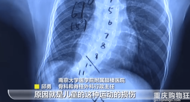 女孩5岁练舞下腰致截瘫，4年后脊柱严重侧弯