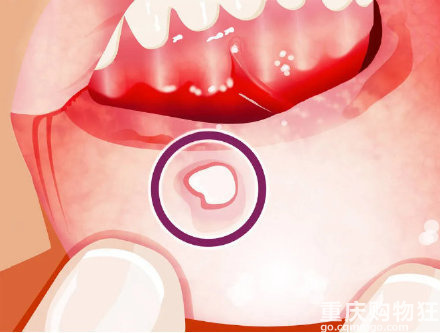 女子反复口腔溃疡确诊舌癌中晚期，医生：溃疡一个月不愈合应就诊-重庆 