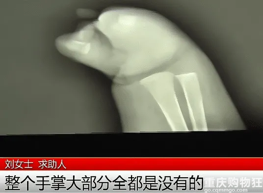怀孕期间都是全套孕检，孩子出生以后没有右手，谁之过？