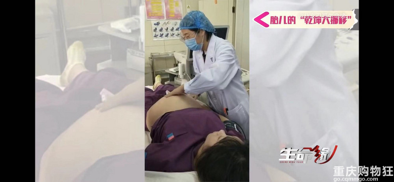 产科主任隔着孕妈肚皮将胎儿倒转180度，纠正胎位！