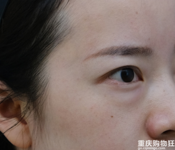 不用拆线的内切祛眼袋，告别大眼袋真香！