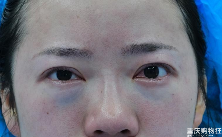 不用拆线的内切祛眼袋，告别大眼袋真香！