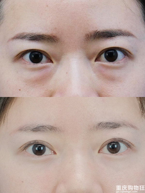 不用拆线的内切祛眼袋，告别大眼袋真香！