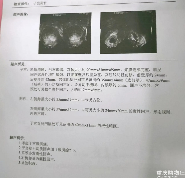 B超上提示这些，说明你可能有子宫腺肌症