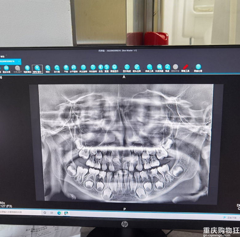 娃儿在治疗牙齿上的长征之路