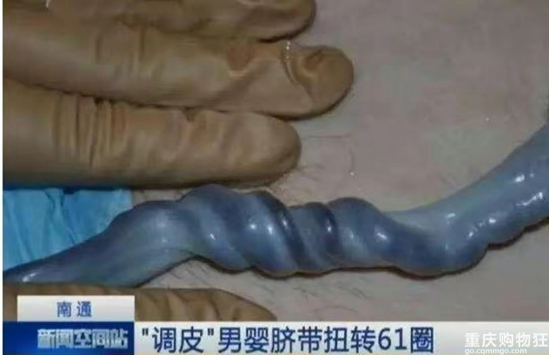 6个月胎儿脐带突然断裂离世，怀孕期间，孕妇要警惕，多加防范