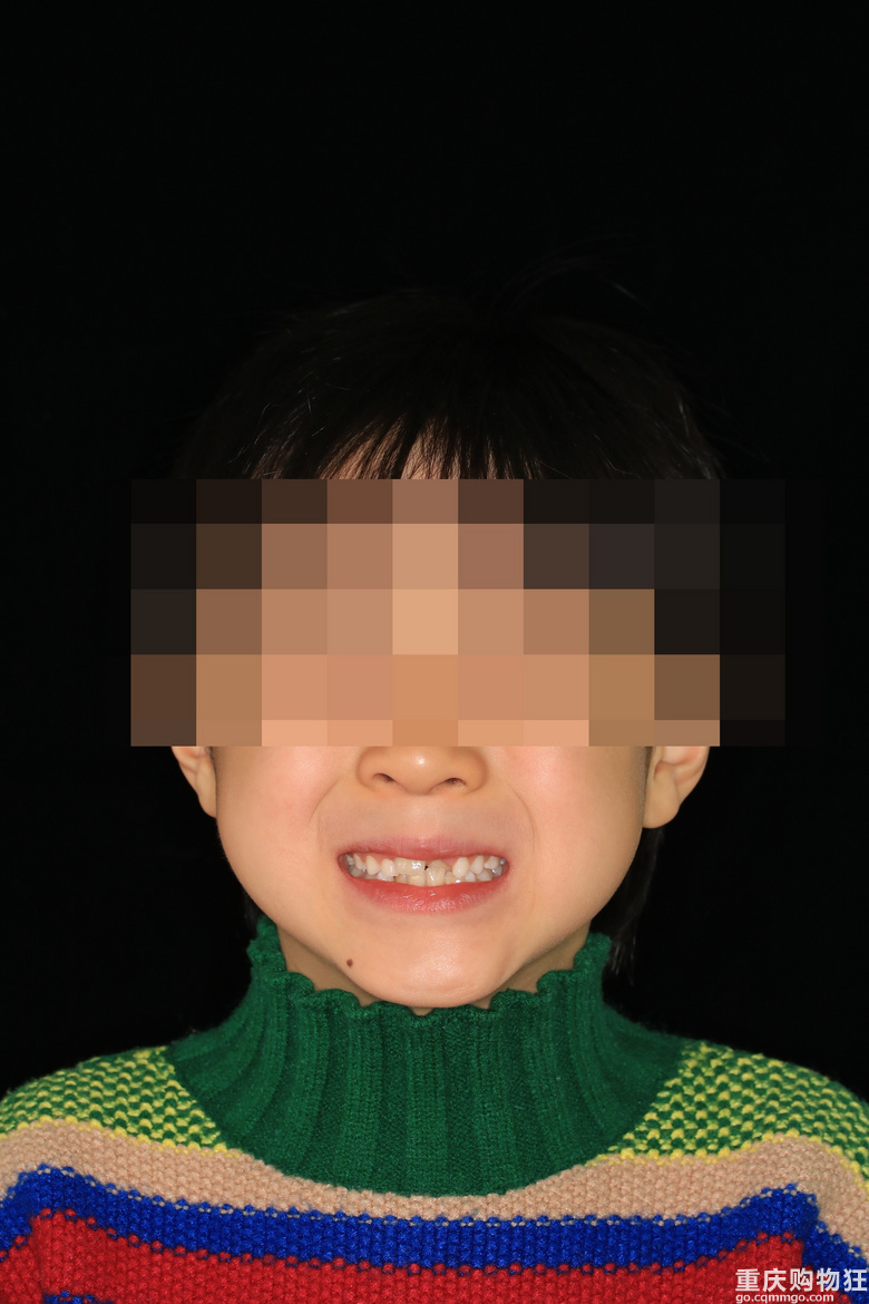 小朋友乳牙掉了后新牙不整齐，在多乐齿科做牙齿矫正，效果明显