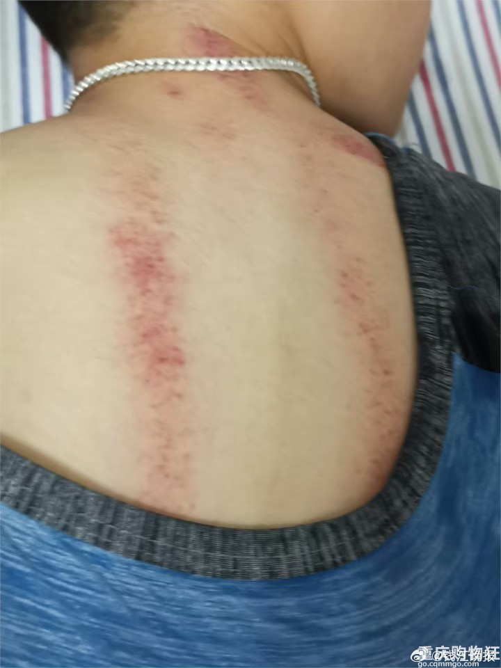 独居老人没开空调致热痉挛咬断两颗牙