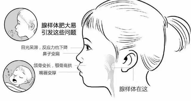孩子睡觉打呼噜张嘴呼吸怎么办？仁品耳鼻喉医院院长微课来了