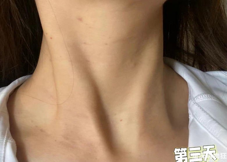 脖子终于干干净净了！没了颈纹，感觉自己都年轻了很多