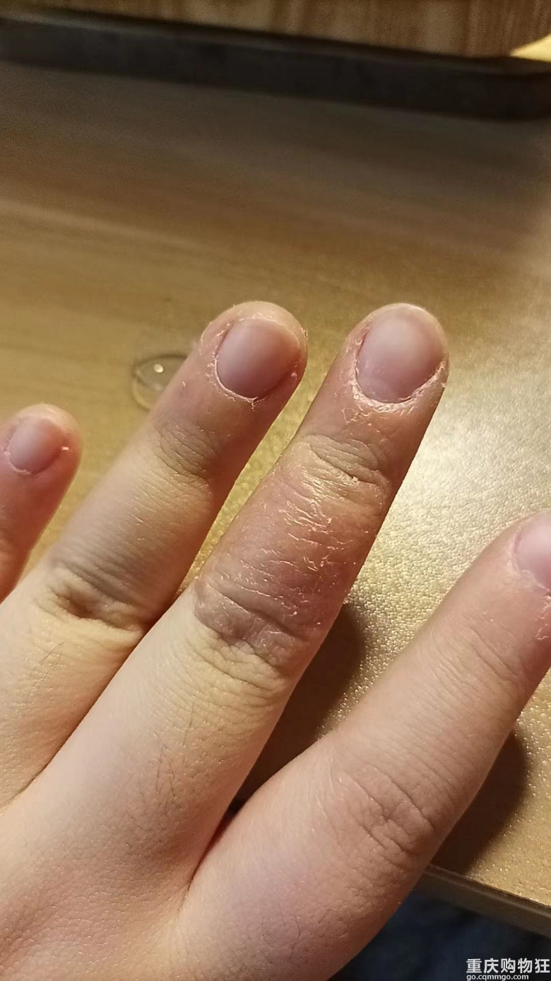 重庆皮肤界的泰斗真不是盖的 一周治好了困扰几个月的皮肤问题
