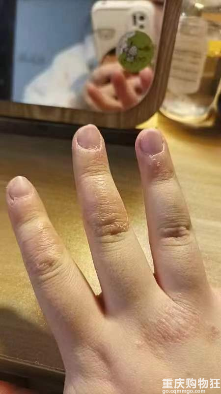 重庆皮肤界的泰斗真不是盖的 一周治好了困扰几个月的皮肤问题