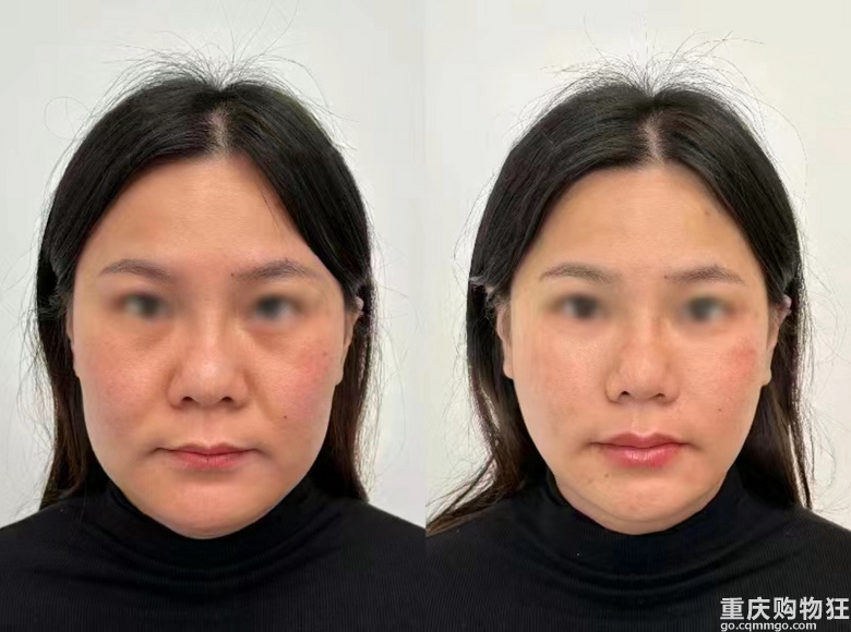 第一次医美分享分享