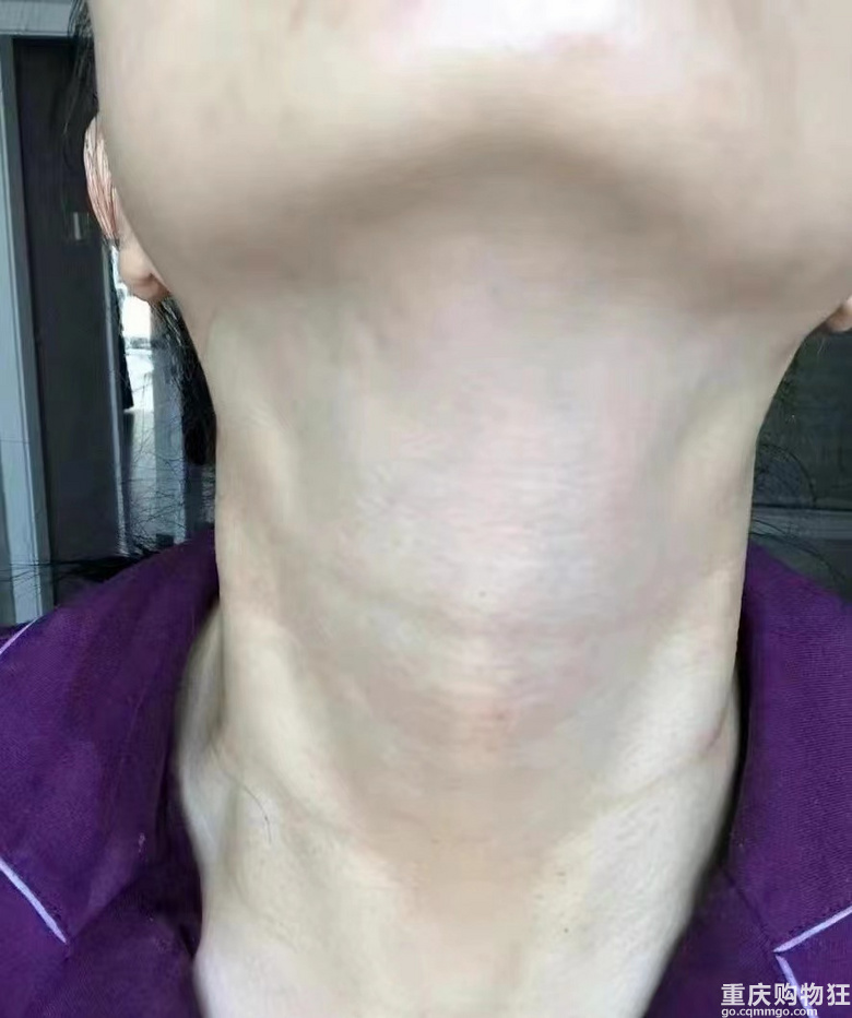 重度颈纹患者算成功上岸了吗？