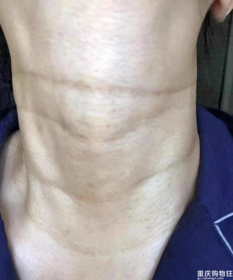 重度颈纹患者算成功上岸了吗？