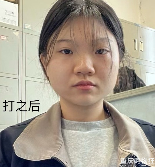 短方脸瘦脸针反馈