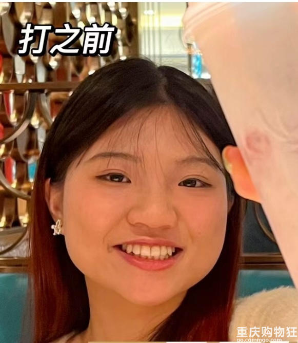短方脸瘦脸针反馈