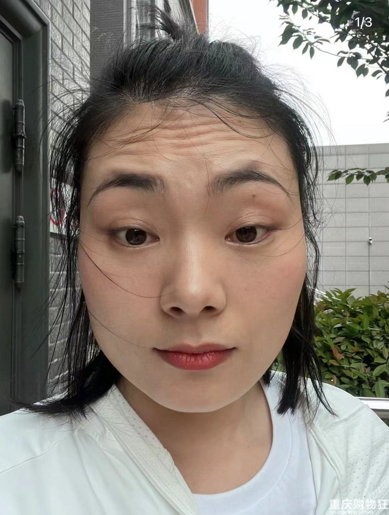 感谢保妥适，拯救了我的抬头纹