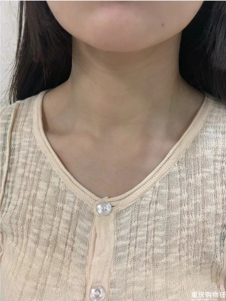 只打了一次颈纹针，效果惊艳