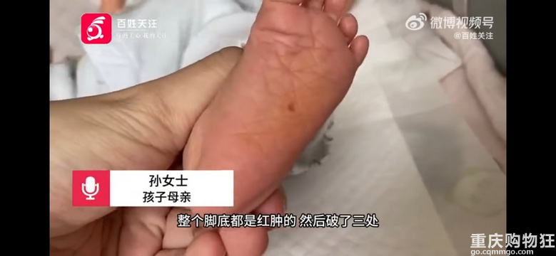 上海一出生12天女婴被月嫂挠伤脚底#月嫂：操作时用力不当