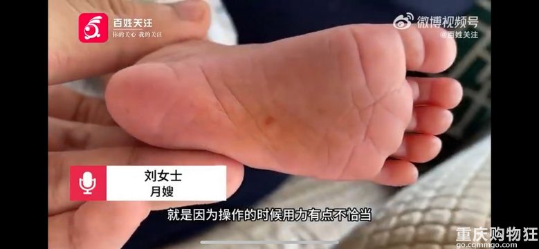 上海一出生12天女婴被月嫂挠伤脚底#月嫂：操作时用力不当
