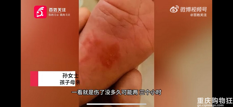 上海一出生12天女婴被月嫂挠伤脚底#月嫂：操作时用力不当