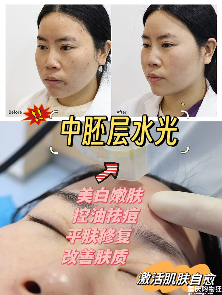 痤疮终于没了,我来分享怎么治好的