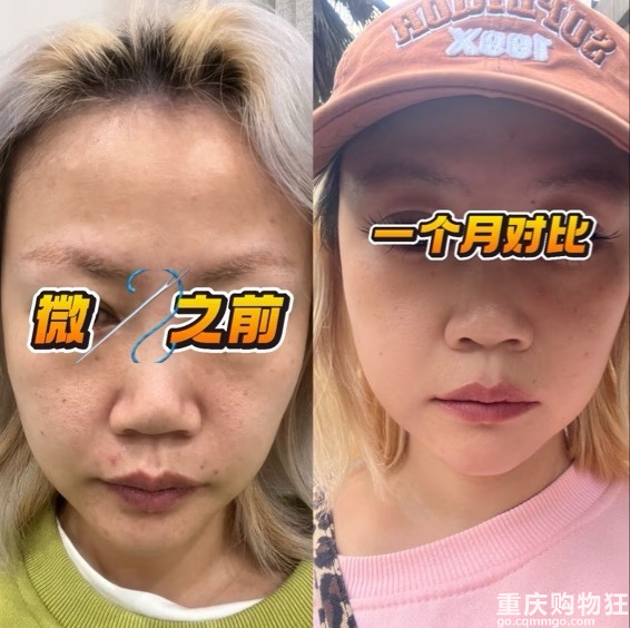 感谢我的医生哄着我把1200发黄金微针打完了