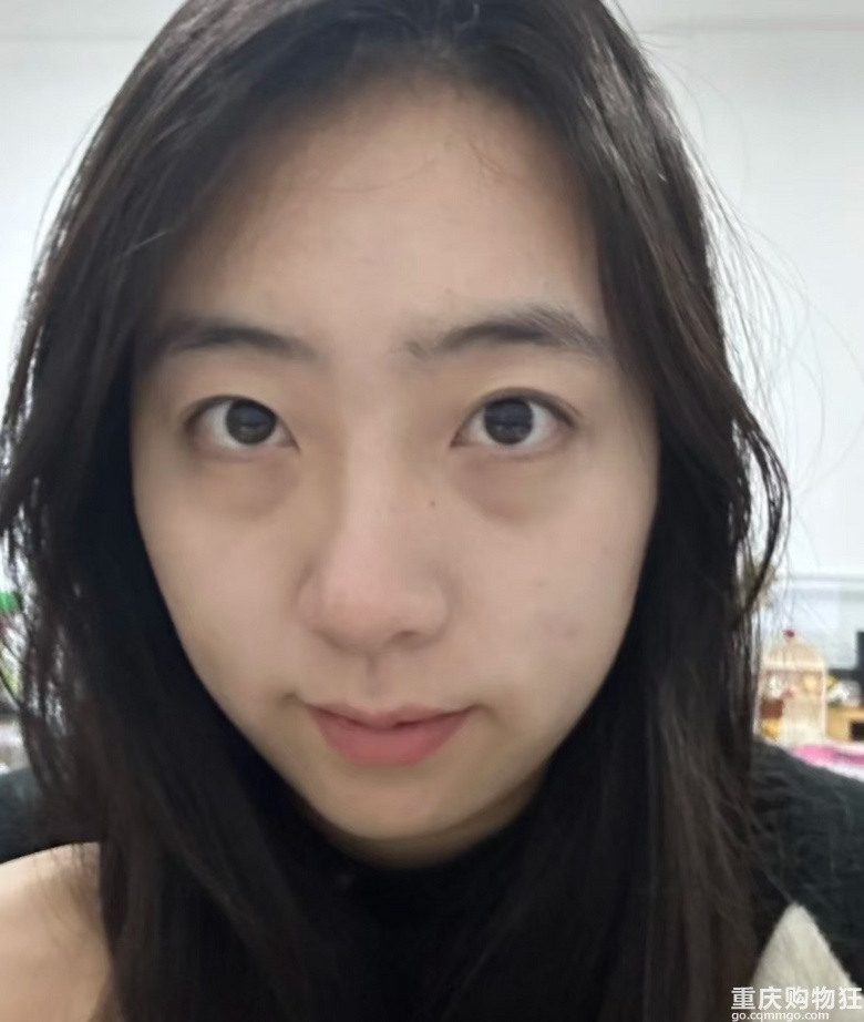 人生头一次填泪沟，没想到效果这么好！
