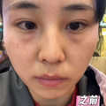 终于和陪伴二十几年的眼袋说拜拜了