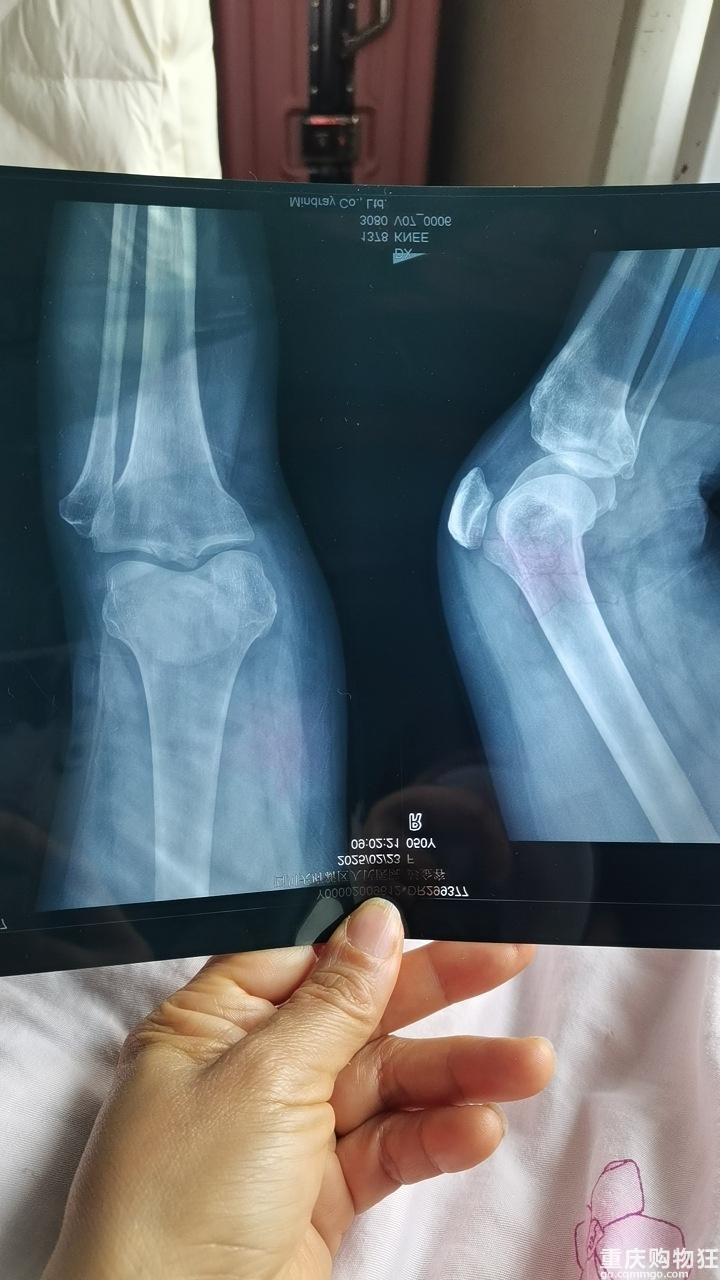 摔了一跤，胫骨平台骨折，是保守治疗好，还是做手术好