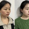 能让问题肌肤一步实现修复+抗衰的黑曜双波微针X，体验感超好！_图2