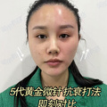 黄金微针5代真实体验分享
