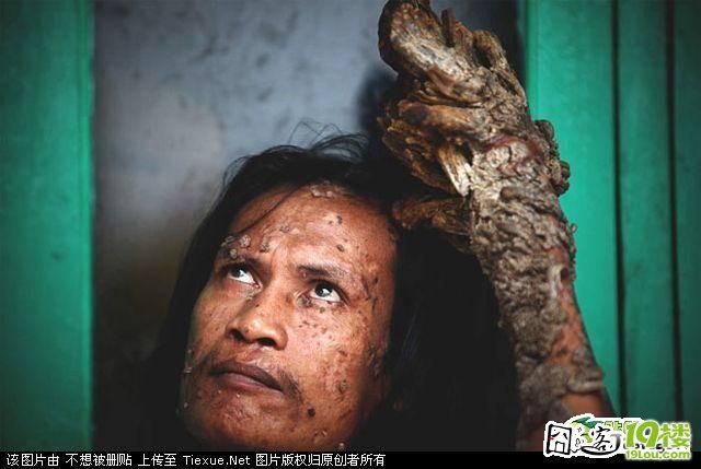 太恐怖了印尼树人患人体乳头状瘤病毒现代医学无法根治