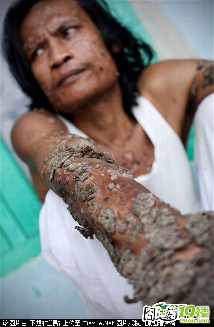 印尼树人照片手术图片