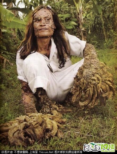 印尼树人是什么病图片