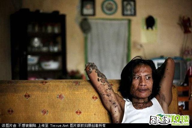 (太恐怖了)印尼树人患人体乳头状瘤病毒 现代医学无法根治