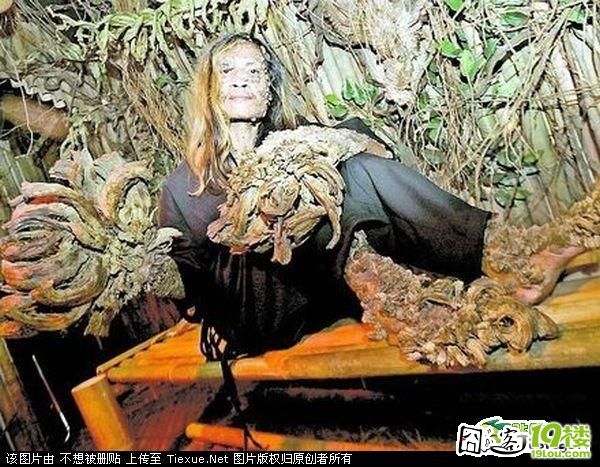 印尼树人临床图片