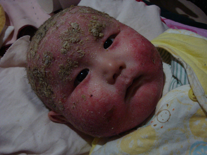 触目惊心的儿子湿疹时候的照片(最新更新儿子