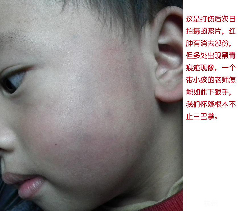 温州宝宝乐幼儿园掌掴两岁宝宝至耳聋