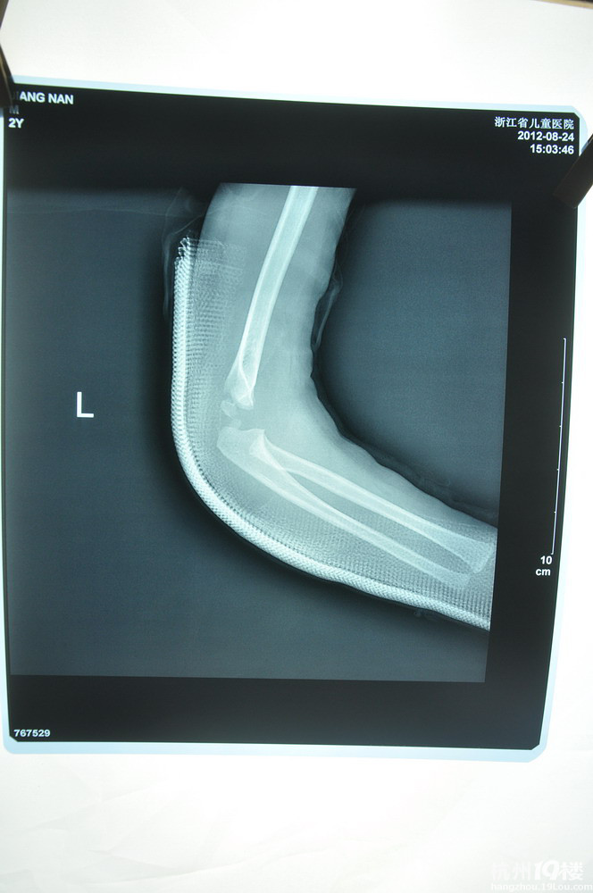 左肱骨远端骨折图片图片