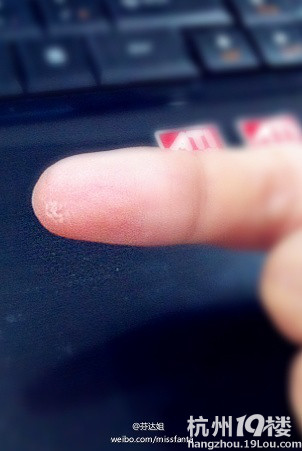 苹果控女孩患苹果手 指腹起茧腕关节痛-手