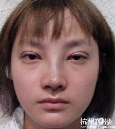 北京扇形重睑+膨体隆鼻+耳软骨垫鼻尖