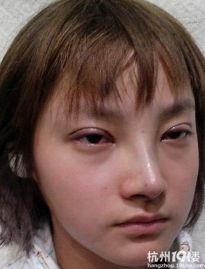 北京扇形重睑+膨体隆鼻+耳软骨垫鼻尖
